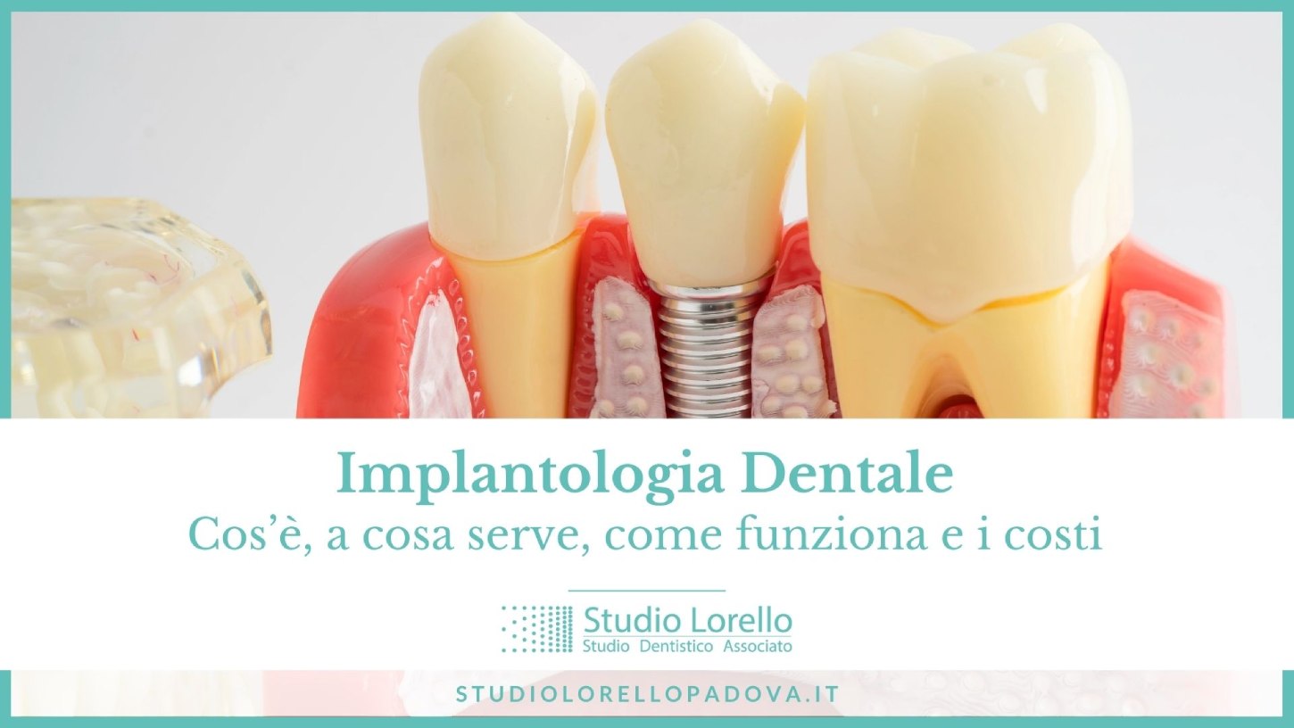 implantologia dentale: cos'è, come funziona, a cosa serve, costo e prezzo